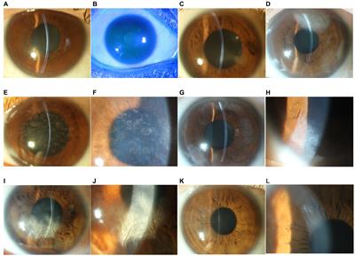 Three-dimensional in vivo evaluation of the cornea in patients with unilateral posterior interstitial keratitis